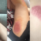 Lee County, Florida — A traumatic incident involving a group of teenage girls in Lee County has left one girl hospitalized with severe injuries and another with a broken foot, sparking outrage over the response by authorities and emergency medical personnel.